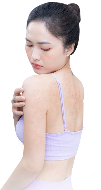 BIẾN CHỨNG CỦA VIÊM NANG LÔNG