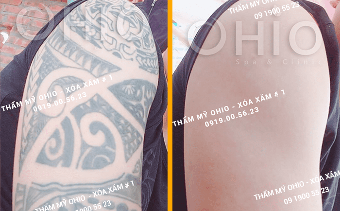 Địa chỉ xóa hình xăm ở Hà Nội