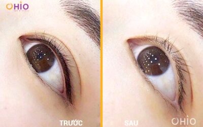 Xóa xăm mí mắt có nguy hiểm không?