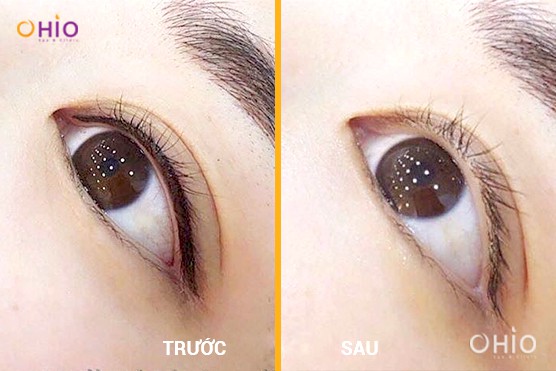 Xóa xăm mí mắt có nguy hiểm không?