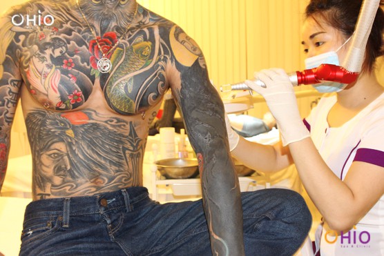 Xóa xăm  nhờ công nghệ Laser