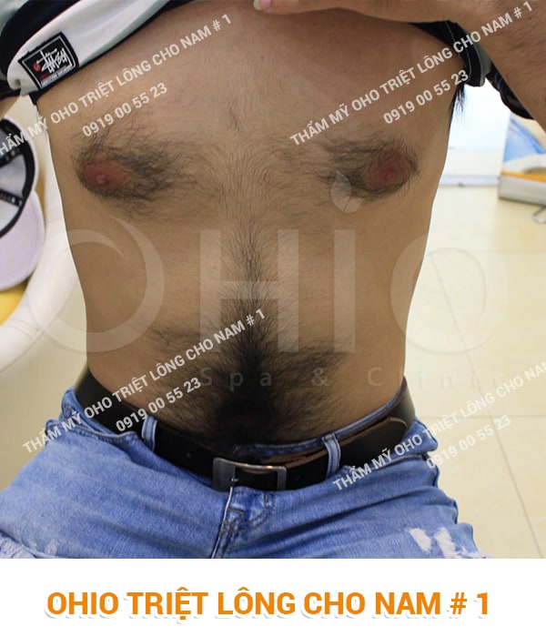 Triệt lông bụng cho nam giới