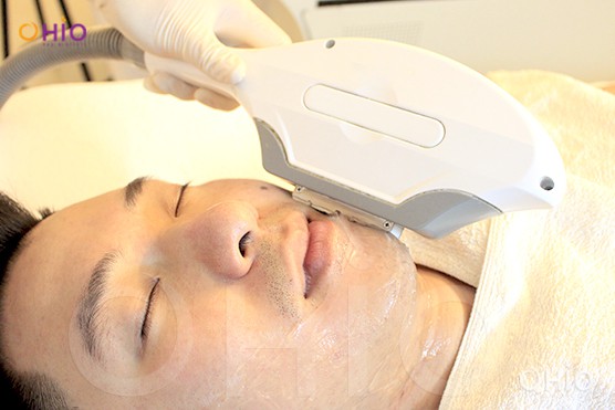Triệt lông cho nam giới bằng laser có an toàn không