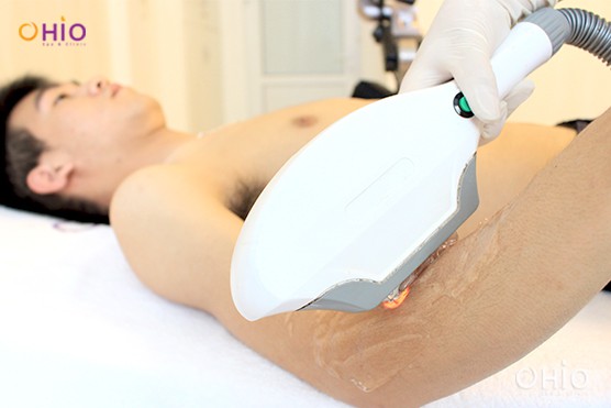 Tìm hiểu về các công nghệ triệt lông cho nam công nghệ cao