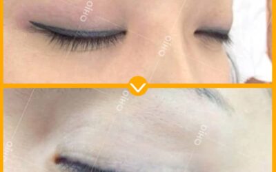 Xóa xăm mí mắt