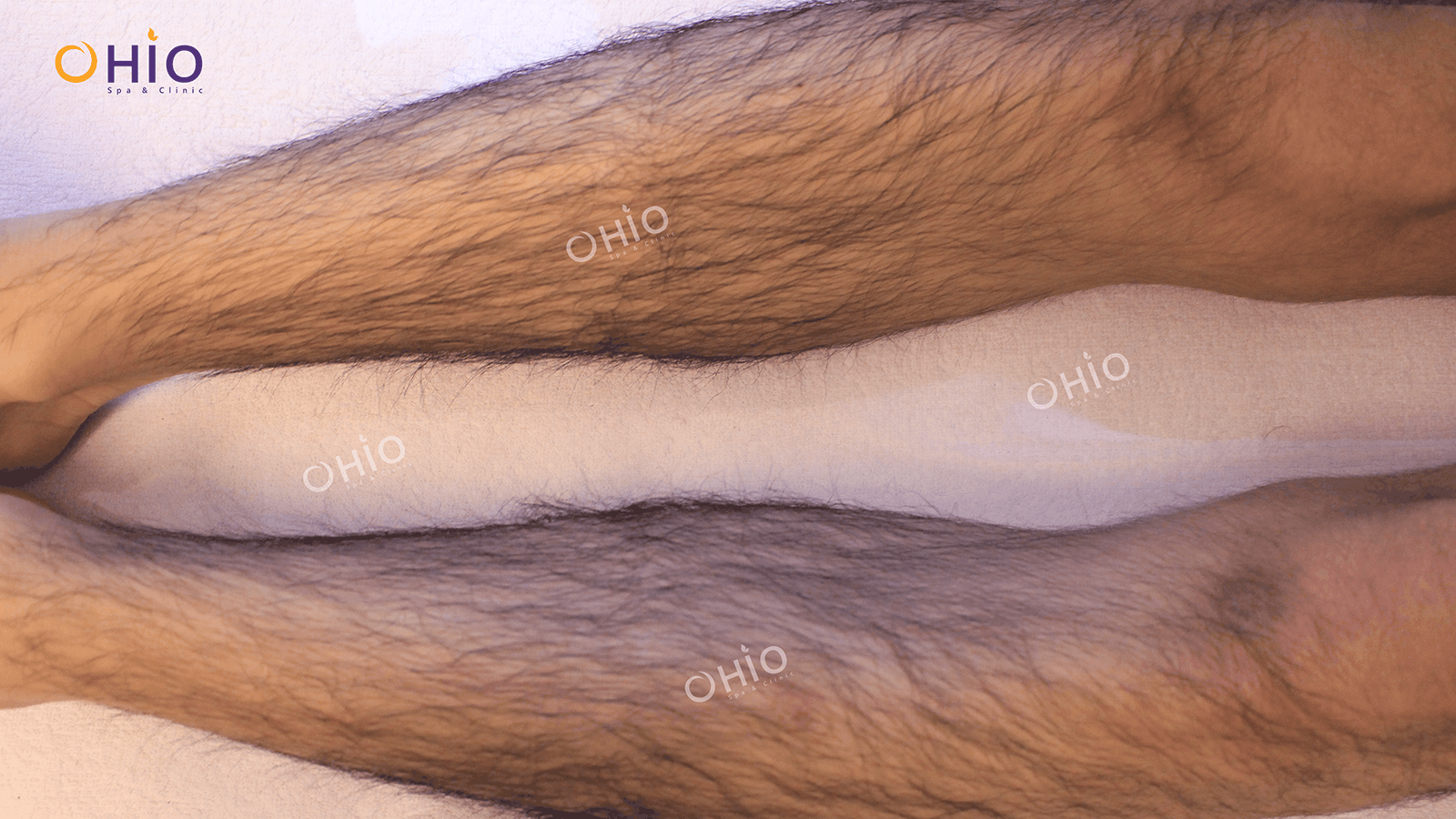 Triệt lông nam - Phòng khám da liễu OHIO Lông chân rậm ở nam giới