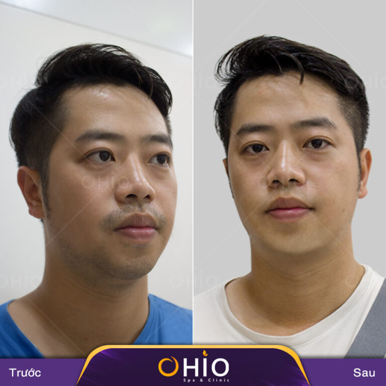 Triệt lông nam ở đâu thì tốt? - địa chỉ triệt lông tiêu biểu được cánh mày râu rỉ tai nhau!