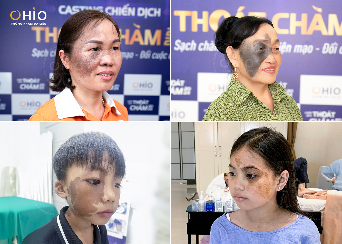 XÓA CHÀM BỚT VÙNG MẶT BẰNG PHƯƠNG PHÁP NÀO HIỆU QUẢ?
