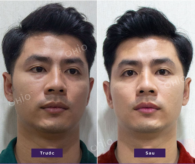 Quy trình khử thâm môi nam không hóa chất – 1h hết thâm, hiệu quả 5 năm