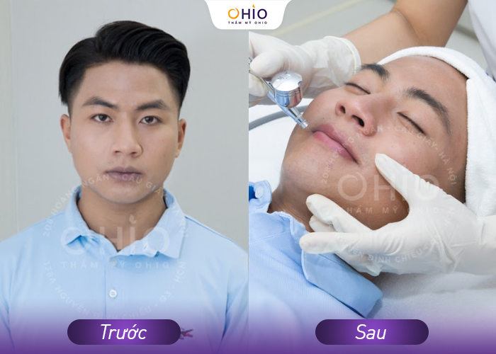 Khử thâm môi nam có khó không và cách thức tiến hành