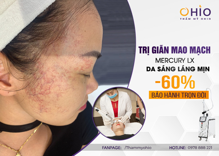 Trị giãn mao mạch Mercury LX – Vị trí nào cũng sạch