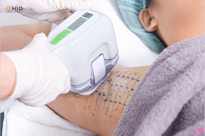 Trị hôi nách không cần phẫu thuật với công nghệ Master Dry