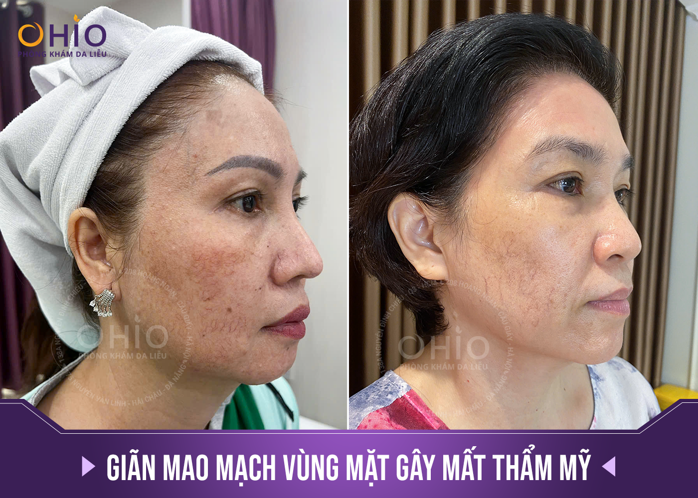 Trị giãn mao mạch ở đâu thì chấm dứt, da đẹp không tì vết?