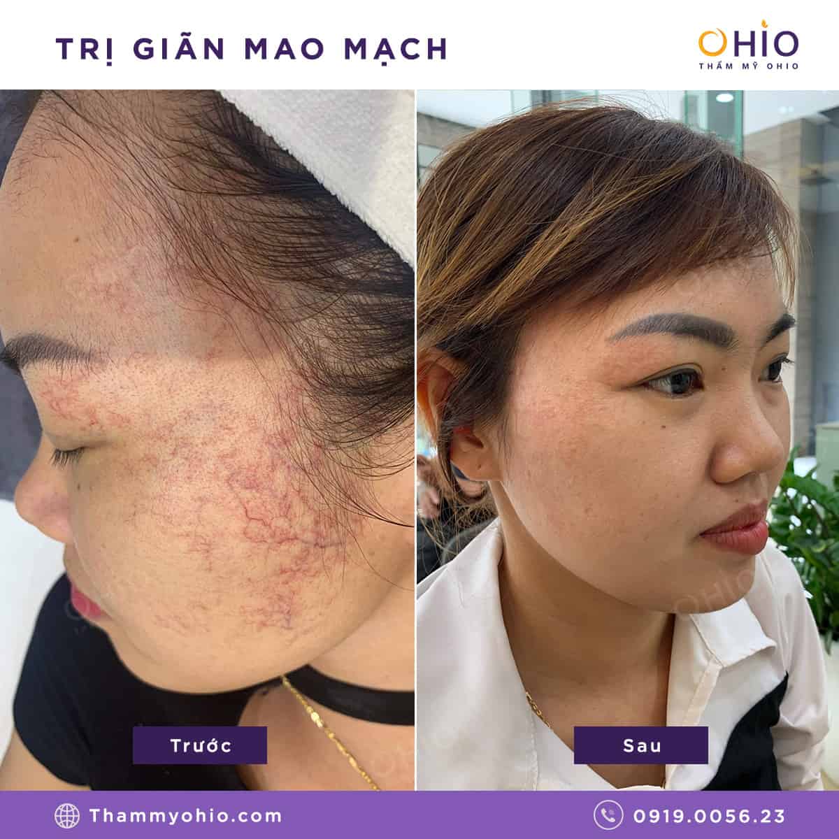 Trị giãn mao mạch ở đâu tốt & có thể “xóa sổ” ?