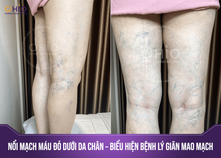 Dấu hiệu giãn mao mạch và cách điều trị an toàn, hiệu quả