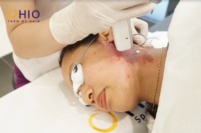 Chàm bớt xanh đen và đỏ có gì khác & phương pháp điều trị chấm dứt