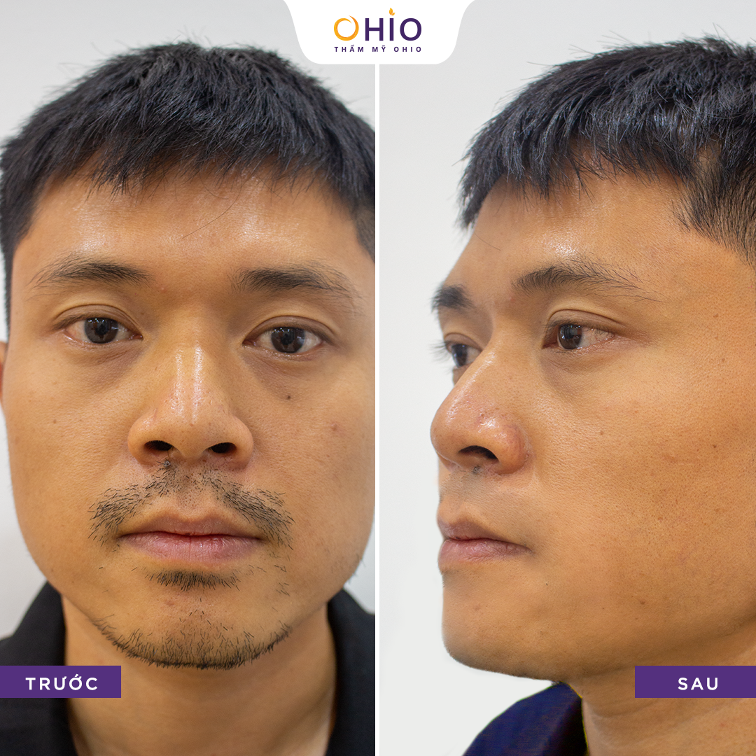 Hình ảnh đầy tự tin của khách hàng sau khi triệt lông tại Thẩm mỹ OHIO