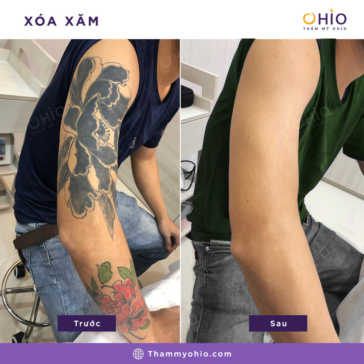Địa chỉ xóa xăm uy tín, khách hàng tin chọn nhiều  tại Hà Nội