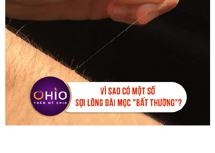 Vì sao có một số sợi lông dài mọc “BẤT THƯỜNG” trên cơ thể?