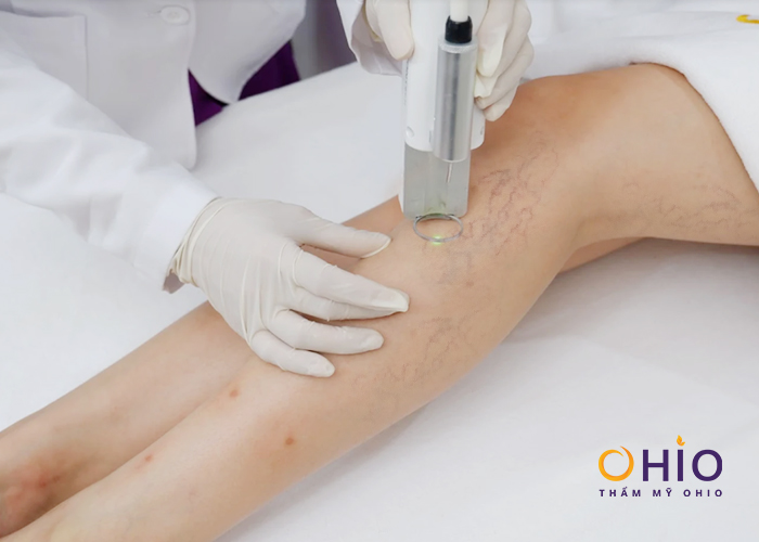 Trị giãn mao mạch chấm dứt tại chuyên khoa Da liễu công nghệ cao