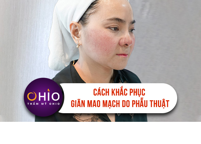 Sau phẫu thuật thẩm mỹ bị giãn mao mạch phải làm sao?