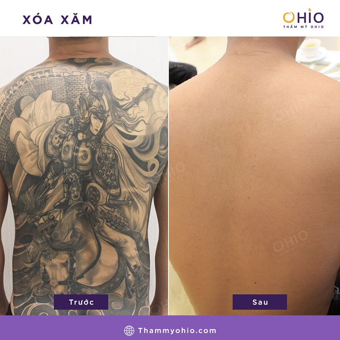 Tổng hợp những hình ảnh xóa xăm mãn nhãn tại Thẩm mỹ OHIO 