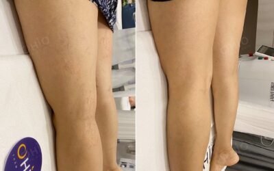 Điều trị giãn mao mạch vùng chân và đùi