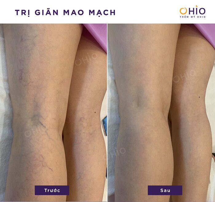 Kết quả điều trị giãn mao mạch chân tại OHIO