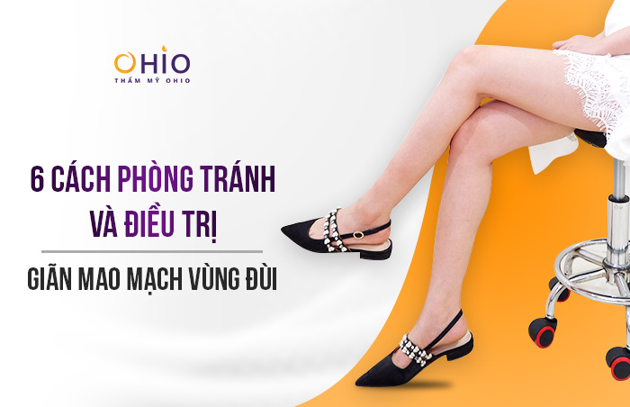 6 cách phòng tránh và điều trị giãn mao mạch vùng đùi an toàn, hiệu quả