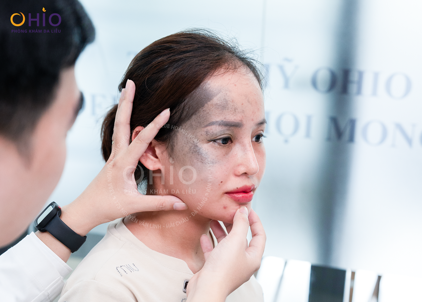 CÁCH XÓA CHÀM BỚT XANH ĐEN AN TOÀN, HIỆU QUẢ