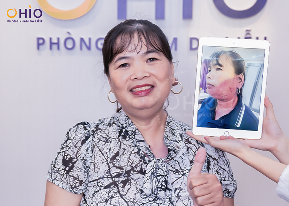 Chàm bớt đỏ bẩm sinh có xóa được không?