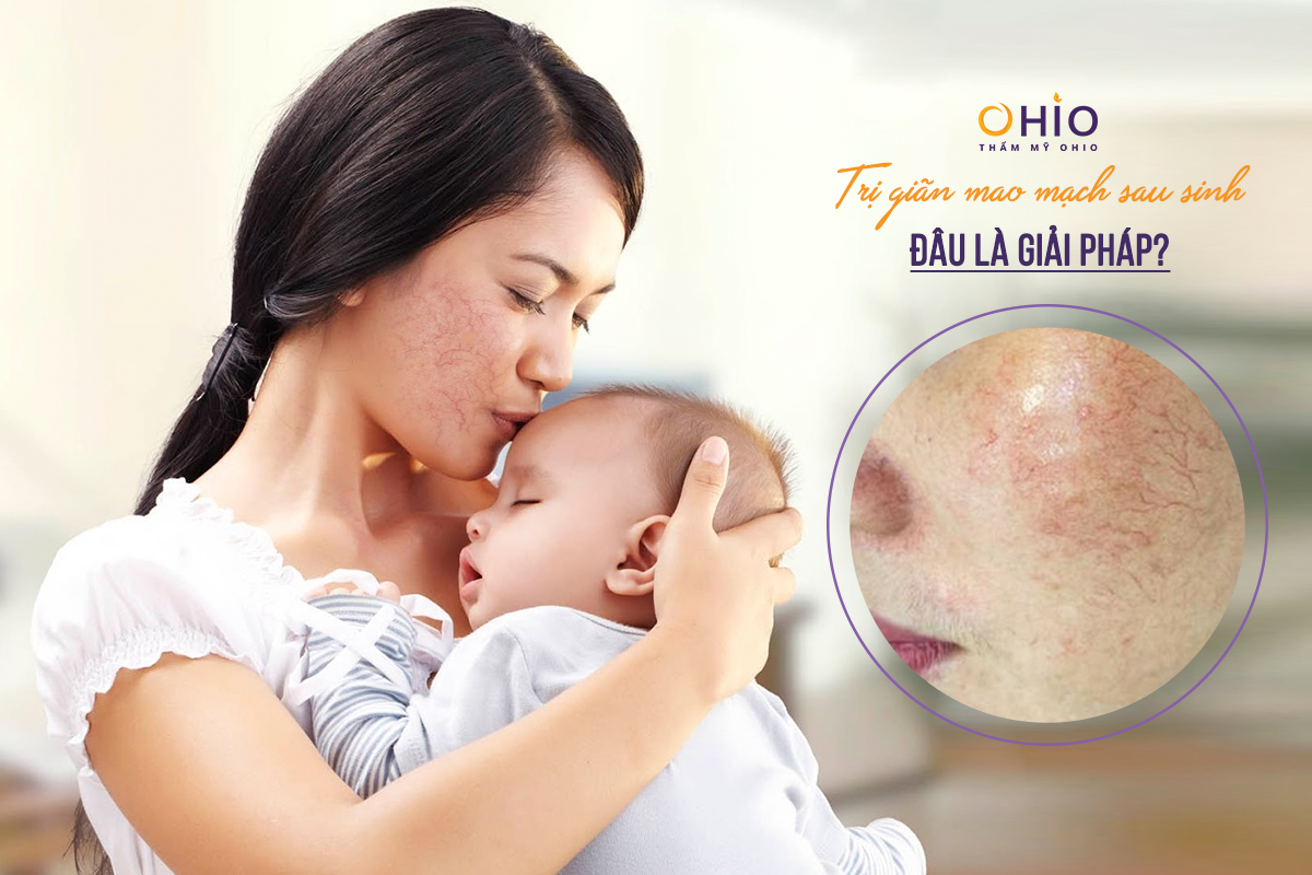Từ A – Z về trị giãn mao mạch sau sinh dưới góc nhìn chuyên gia