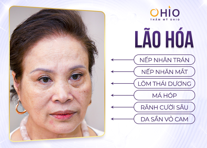 Trẻ hóa, xóa nhăn bằng Meso / HA / BAP - Phòng khám da liễu OHIO Các dấu hiệu lão hóa da thường gặp