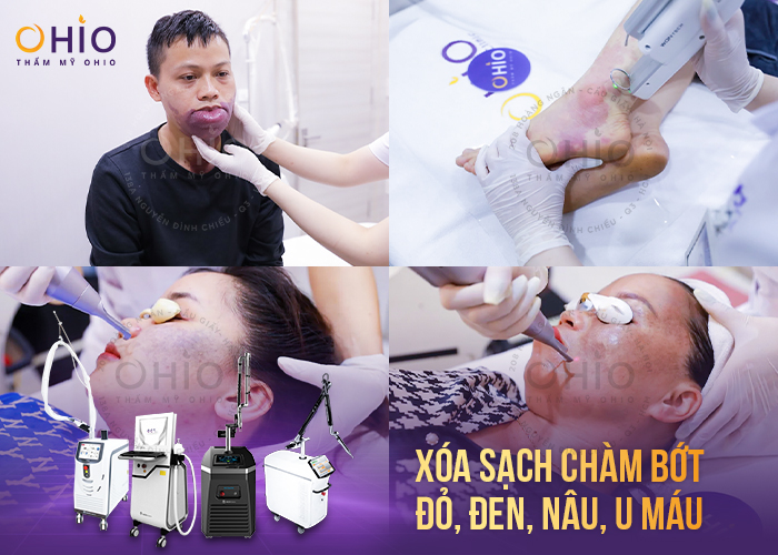 Tổ hợp công nghệ xóa chàm bớt tại chiến dịch “Thoát bớt” mùa 1
