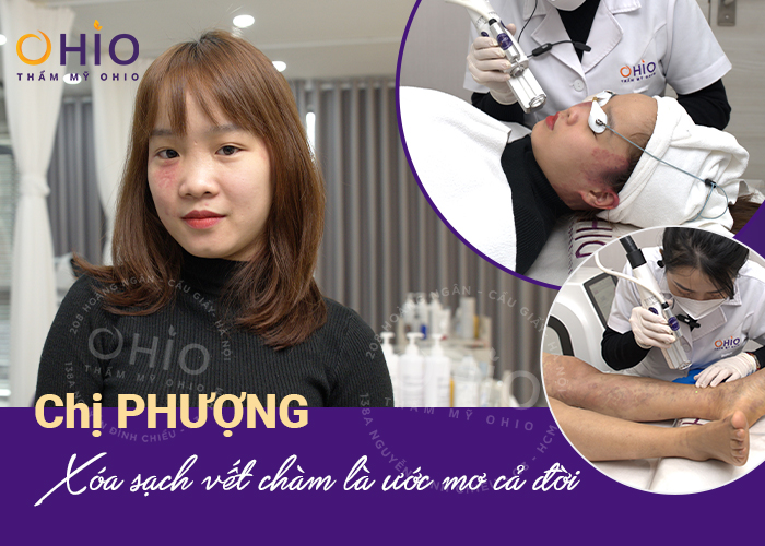Chị Phượng (Thái Nguyên): Xóa sạch chàm bớt là ước mơ cả đời