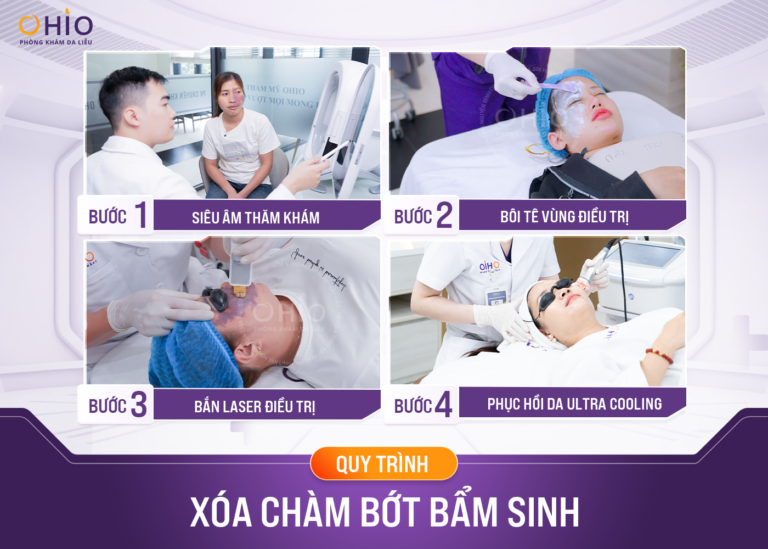 [Bật mí] Cách xóa vết bớt bẩm sinh hiệu quả, không đau đớn