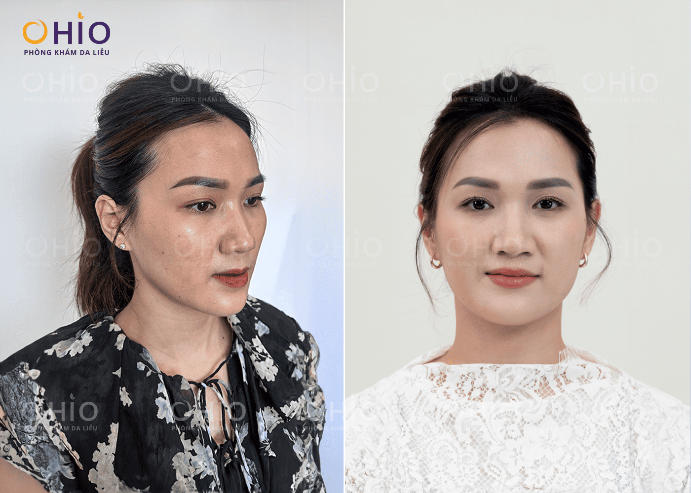 Chị Thùy Linh (35 tuổi) - Làm đầy vùng má hóp và cấy trẻ hóa da với Siêu Phác đồ Reborn Lift
