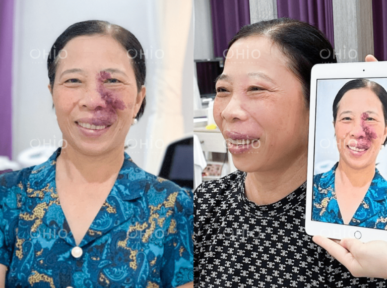 Cô Cao Thị Liễu (54 tuổi) xóa sạch chàm đỏ, u máu thành công