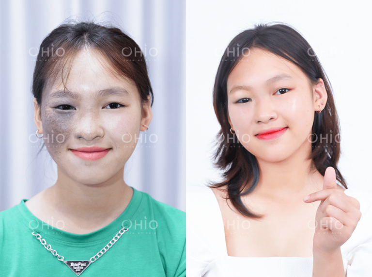 Em Ngọc Ánh (16 tuổi) xóa sạch chàm sắc tố bẩm sinh thành công