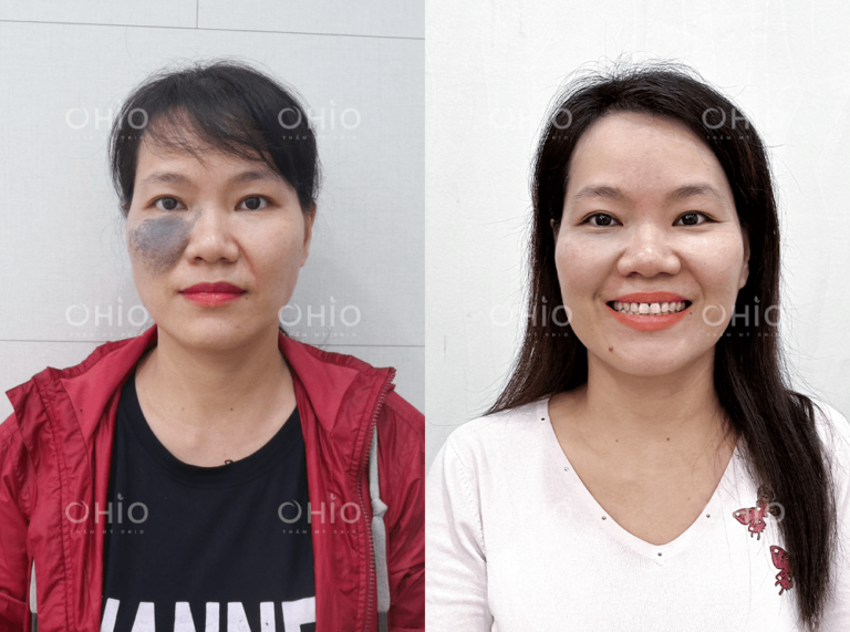 Chị Kim Ly (32 tuổi) xóa chàm sắc tố xanh đen bẩm sinh