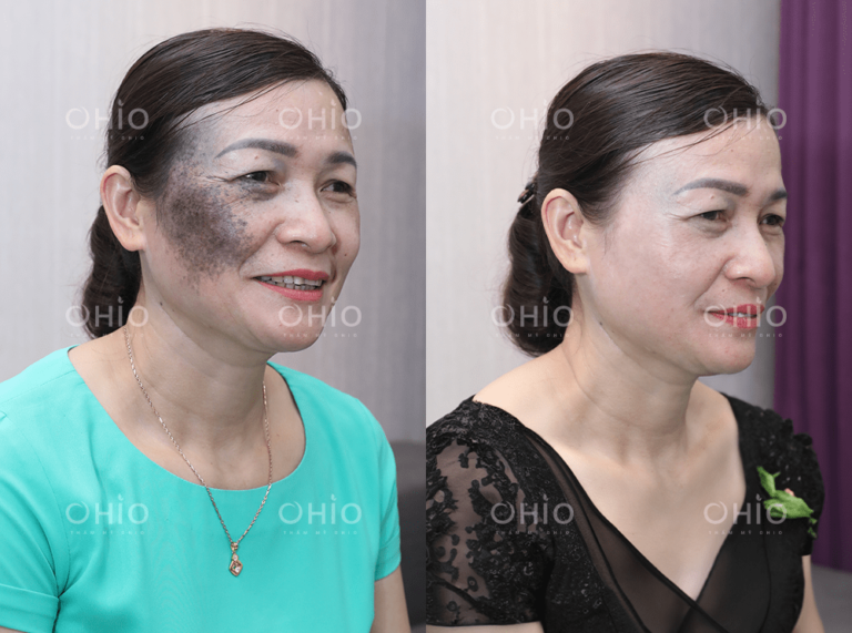 Chị Lê Thương (50 tuổi) xóa sạch chàm sắc tố đen bẩm sinh