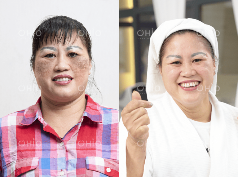 Chị Phương Thảo (43 tuổi) xóa sạch chàm sắc tố tăng sinh bẩm sinh