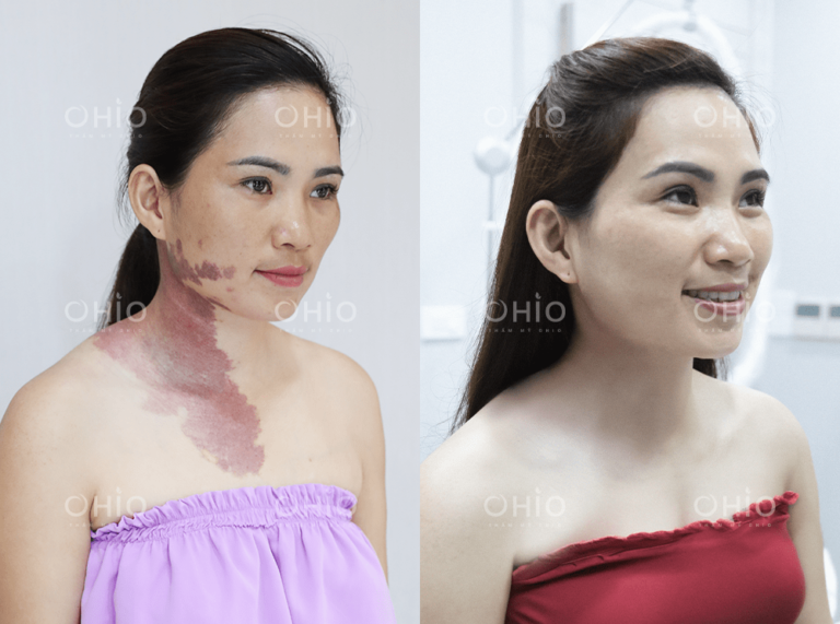 Chị Mỹ Oanh (41 tuổi) xóa chàm đỏ rượu vang thành công
