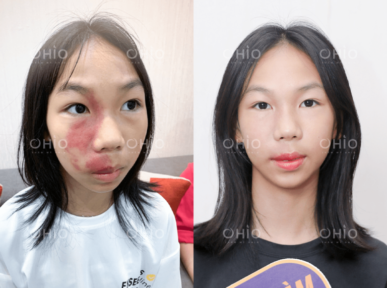 Em Linh Phương (14 tuổi) xóa chàm đỏ rượu vang thành công