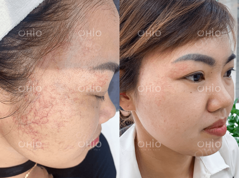 Chị Mai Nguyễn ( 29 tuổi) trị giãn mao mạch vùng má hiệu quả