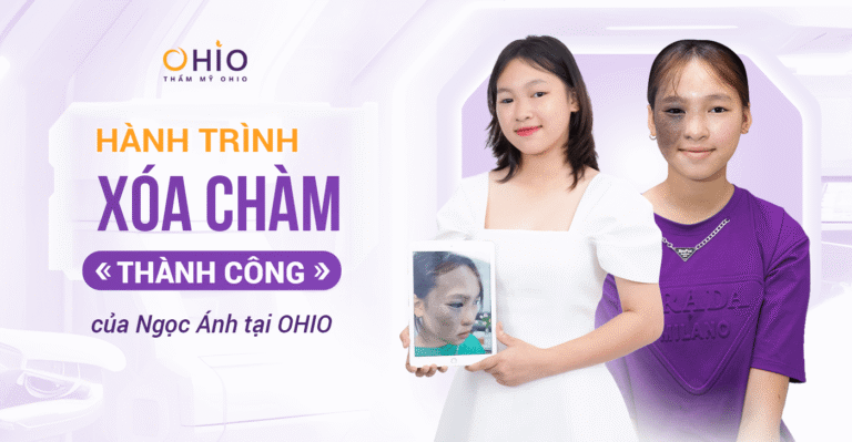 Ngọc Ánh 16 tuổi: Sạch chàm bớt đen nửa mặt sau 1 liệu trình tại OHIO