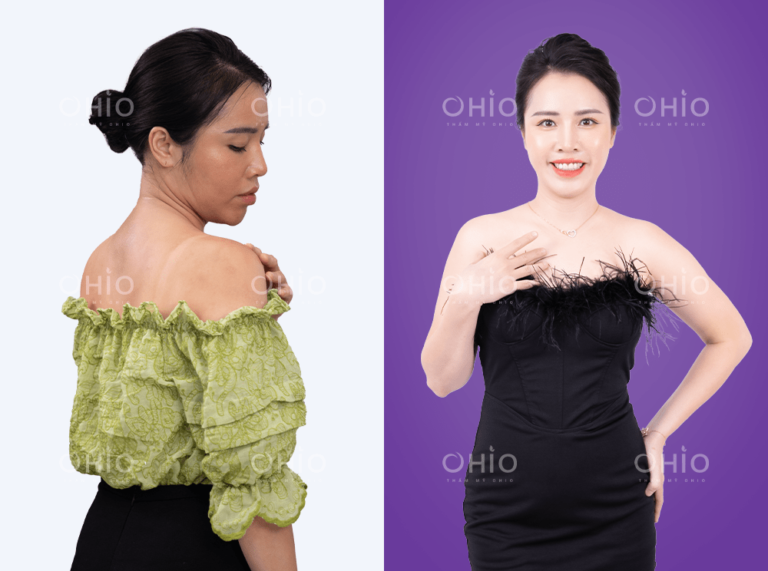 Chị Mai Liên hết da ngăm đen bẩm sinh sau liệu trình tắm trắng