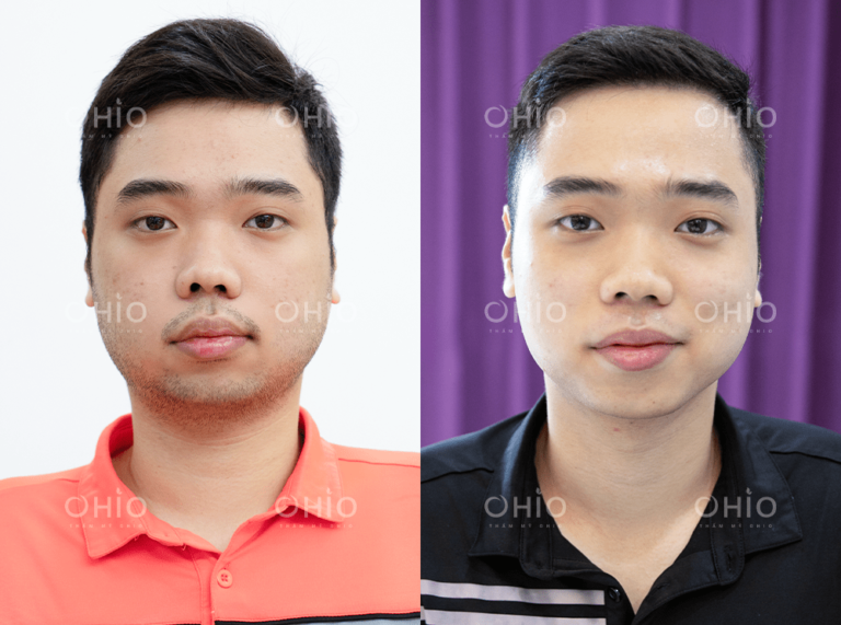 Anh Quốc Hải (27 tuổi) triệt sạch râu quai nón, mép cằm sau liệu trình ngắn