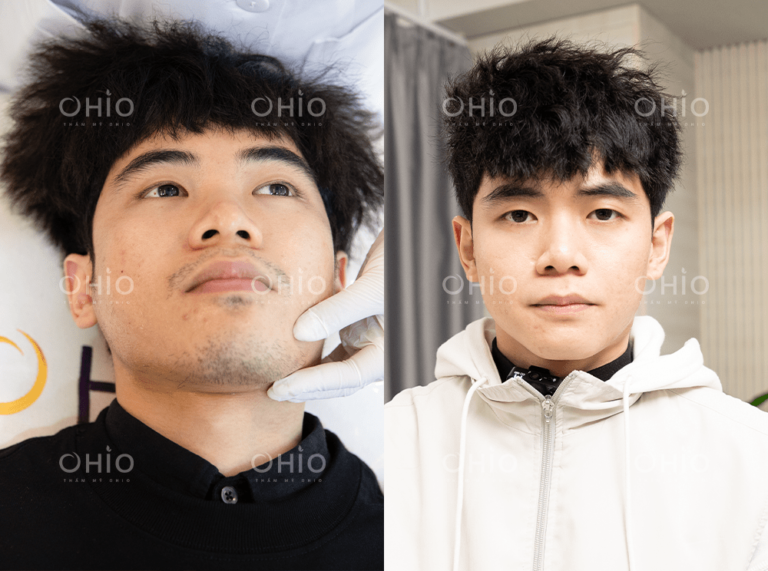 Anh Vi Đạt (21 tuổi) triệt sạch râu mép cằm, da sáng mịn sau liệu trình ngắn