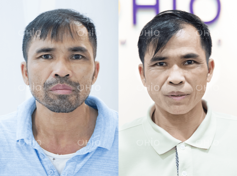 Anh Văn Công (48 tuổi) triệt sạch râu mép cằm, quai nón sau liệu trình ngắn